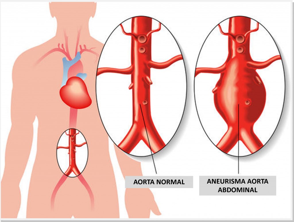 aneurisma da aorta abdominal tratamento em sinop